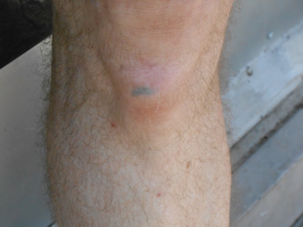 2014-08-28 Asphalt in My Right Knee